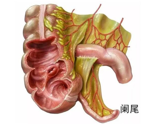 L'appendice non solo può infiammarsi, ma può anche subire cambiamenti cancerosi! Può rappresentare un rischio di vita simile a quello del cancro del colon-retto.