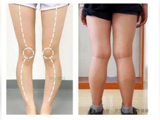 Le solette personalizzate stampate in 3D di BASINGLEAD aiutano a risolvere il problema delle "gambe a X"