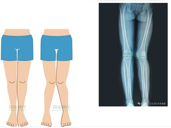 Le solette personalizzate stampate in 3D di BASINGLEAD aiutano a risolvere il problema delle "gambe a X"