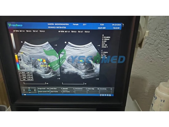 L'ecografo color doppler portatile YSENMED YSB-M5 funziona bene in un ospedale dello Zimbabwe.