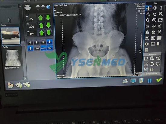 Il radiologo messicano è soddisfatto del sistema radiografico digitale portatile YSENMED YSX056-PE
