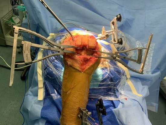 Divaricatore di bilanciamento del divario medico di Shandong LiangMed con cuscinetto circolare o quadrato
