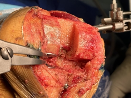 Divaricatore di bilanciamento del divario medico di Shandong LiangMed con cuscinetto circolare o quadrato