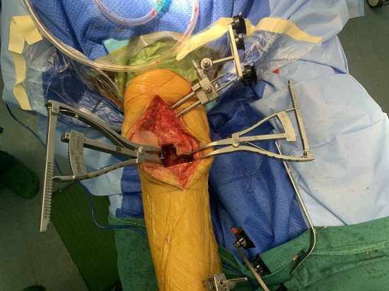 Divaricatore di bilanciamento del divario medico di Shandong LiangMed con cuscinetto circolare o quadrato