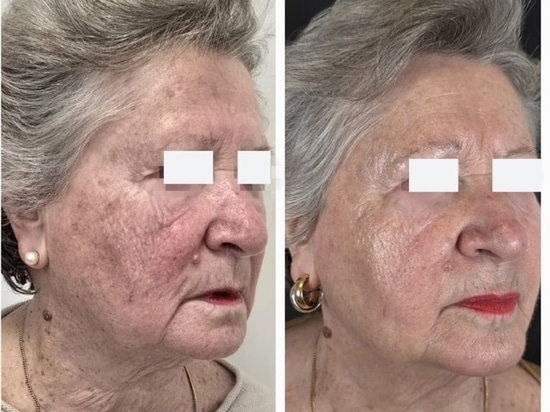 REVYPEEL®: La prossima generazione di biorivitalizzazione senza aghi