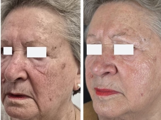 REVYPEEL®: La prossima generazione di biorivitalizzazione senza aghi