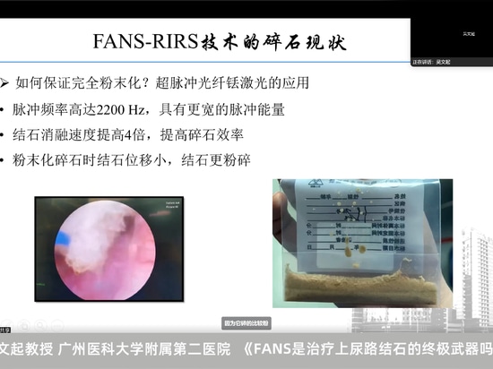 Wenqi Wu: La FANS è l'arma definitiva per il trattamento dei calcoli del tratto urinario superiore?