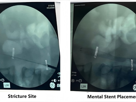 Il Primo Ospedale Affiliato dell’Università di Medicina di Guangzhou ha portato a termine con successo la prima applicazione clinica di un sistema di stent ureterale coperto di produzione nazionale...