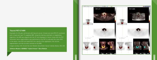 Thyroid PET-CT-MRI