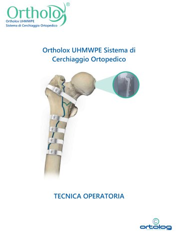 Ortholox UHMWPE Sistema di Cerchiaggio Ortopedico