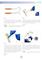 Ortholox UHMWPE Sistema di Cerchiaggio Ortopedico - 5