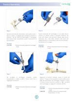 Ortholox UHMWPE Sistema di Cerchiaggio Ortopedico - 6