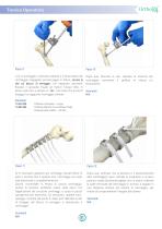 Ortholox UHMWPE Sistema di Cerchiaggio Ortopedico - 7
