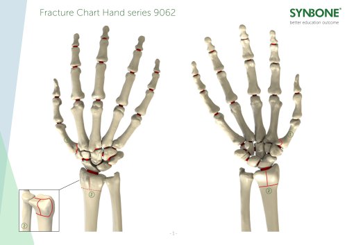 Fracture Charts Hand models 9062 series