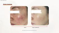 Epilazione DPL PLUS + Filtro DPL per la cura della pelle-17