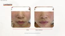 Epilazione DPL PLUS + Filtro DPL per la cura della pelle-18