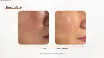 Epilazione DPL PLUS + Filtro DPL per la cura della pelle-19