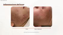 Epilazione DPL PLUS + Filtro DPL per la cura della pelle-20