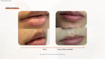 Epilazione DPL PLUS + Filtro DPL per la cura della pelle-21