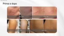 Fractional CO2 Laser-19
