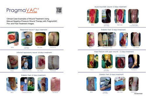 PragmaVAC&reg; Wound Treatment Case Examples