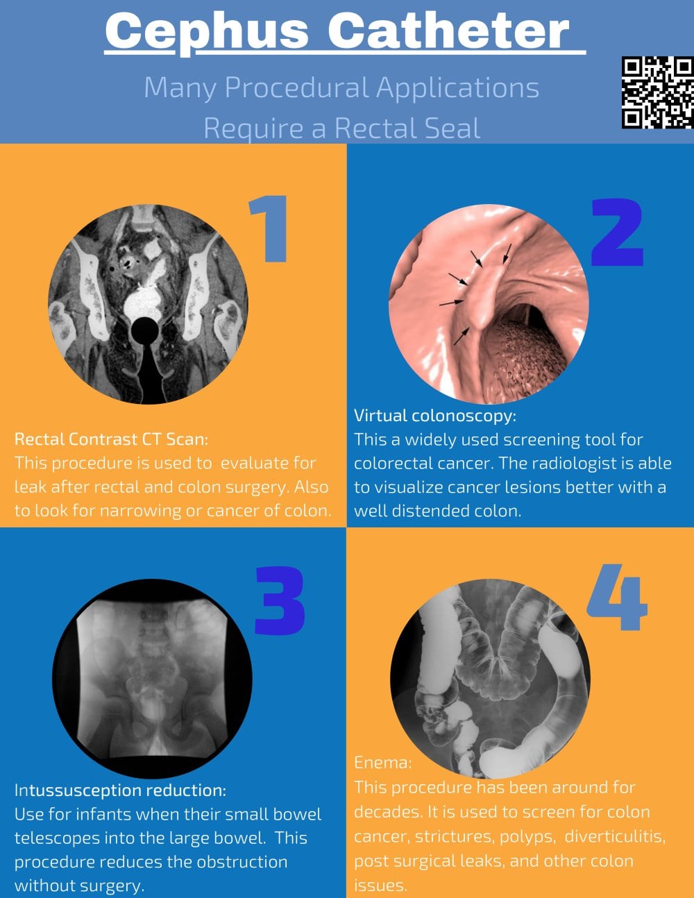 Cephus Catheter - SealCath