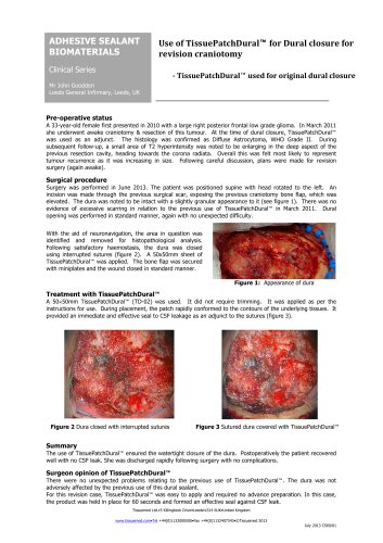 Use of TissuePatchDural? for Dural closure for revision craniotomy